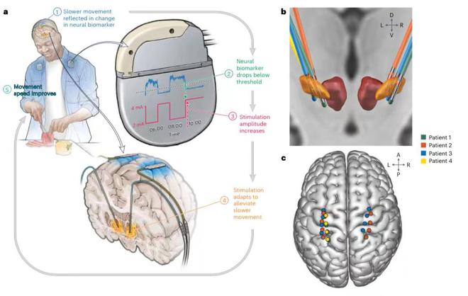 个性化深部脑刺激能减轻帕金森症状患者运乐竞体育平台动症状持续时间减半(图1)
